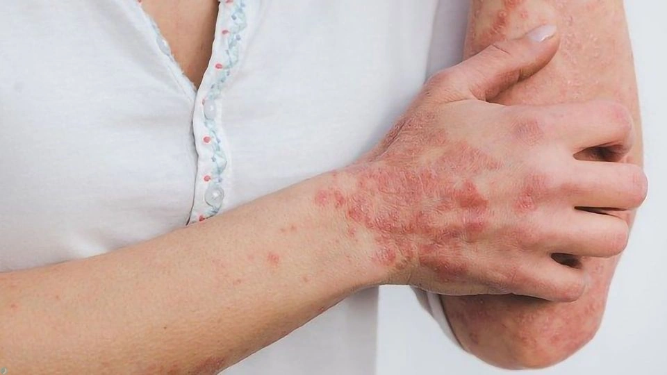 چرا خارش پوست درماتیت آتوپیک خواب شما را خراب می‌کند؟
