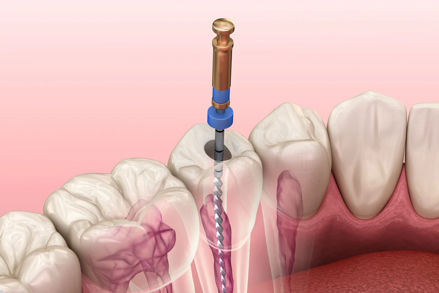 چه زمانی باید برای ترمیم ریشه (روتکانال) اقدام کرد؟ مراحل، درد، بهبودی