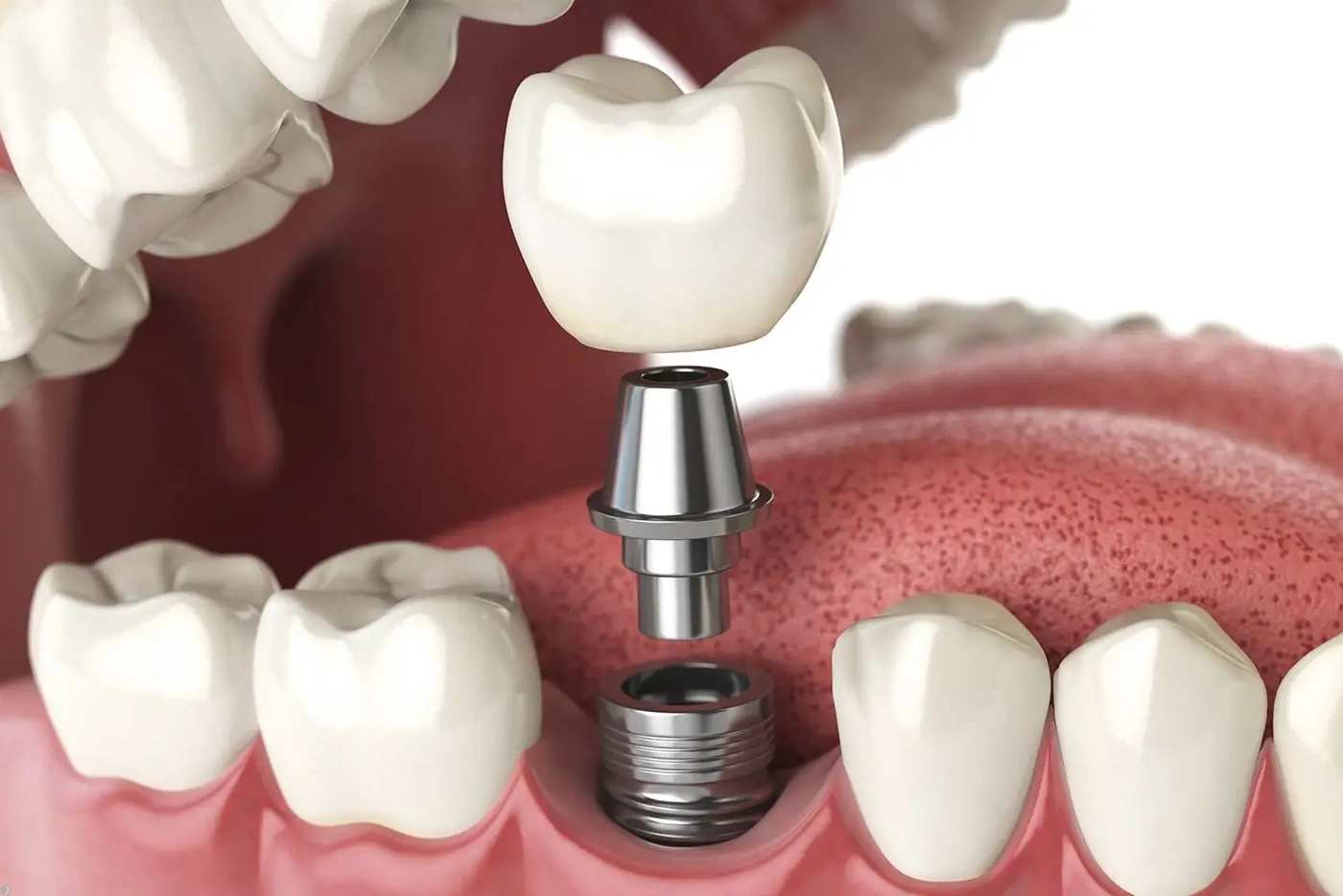 ایمپلنت‌های فوری در مقابل ایمپلنت‌های مرحله‌ای: مقایسه و انتخاب