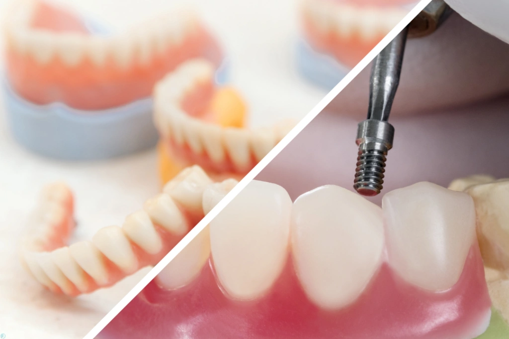 ایمپلنت یا دندان مصنوعی؟ بررسی طول عمر، هزینه و تجربه بیمار