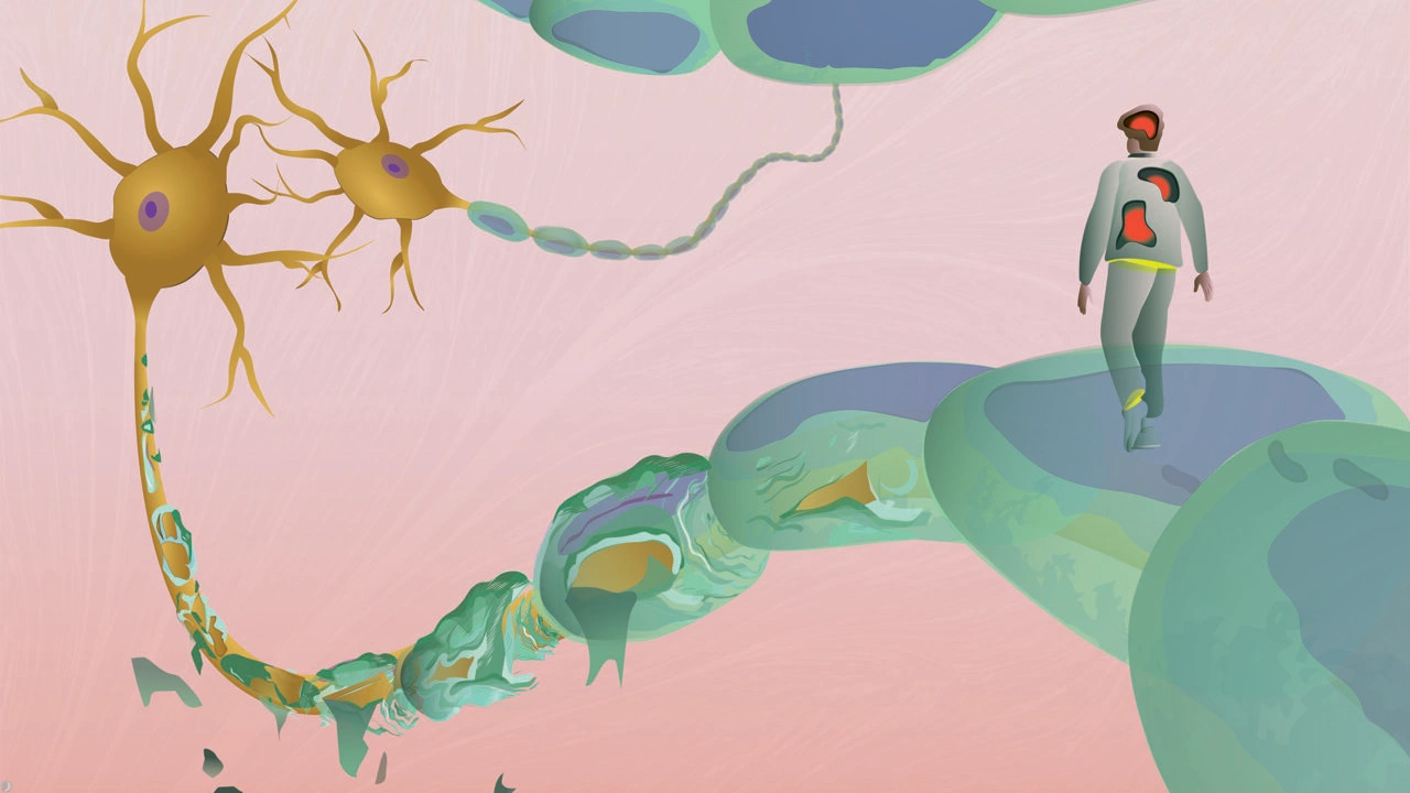 علائم ام اس خاموش چیست؟ نشانه های حسی، حرکتی و بینایی