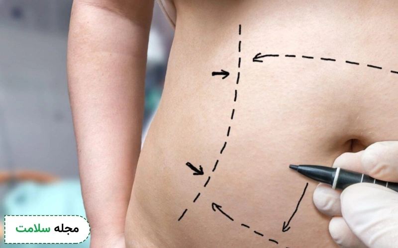 لیفت شکم چیست؟