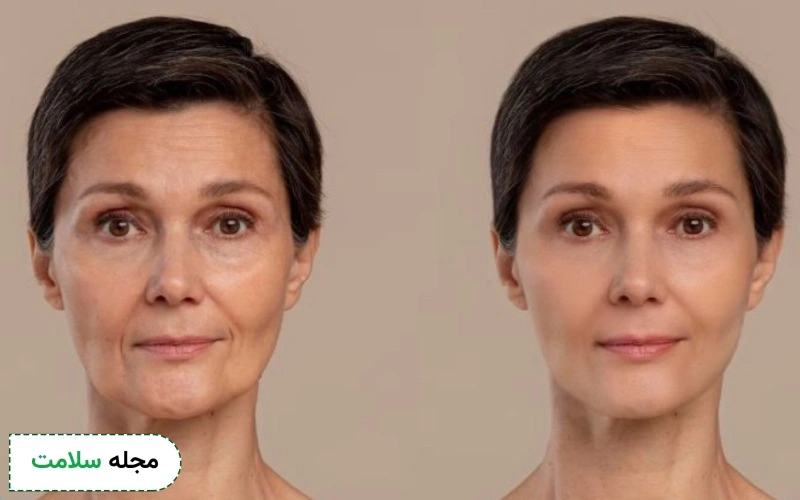 لیفت با ژل چگونه است؟