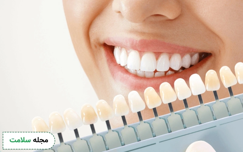 در بلیچینگ دندان از چه موادی استفاده می‌شود؟