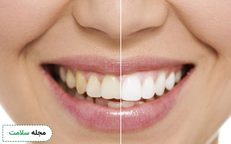 تأثیر کامپوزیت بر سلامت و زیبایی دندان چیست؟