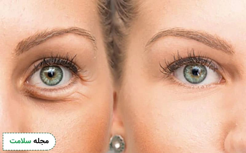 عمل زیبایی بزرگ کردن چشم