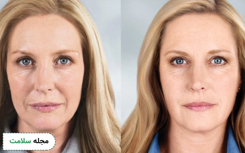 لیفت صورت و گردن چگونه است؟