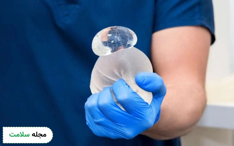 آیا پروتز سینه می ترکد؟