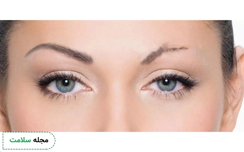 کاشت ابرو چیست