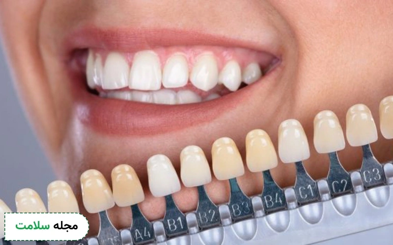 چه کارهایی را قبل از بلیچینگ دندان باید انجام دهیم؟