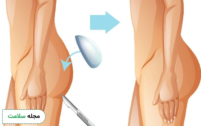 عمل پروتز باسن چگونه است؟