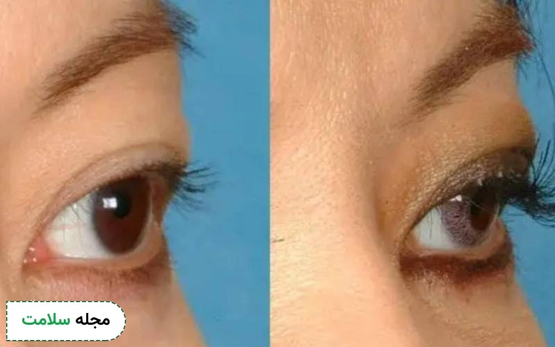 عکس قبل و بعد کاشت مژه طبیعی