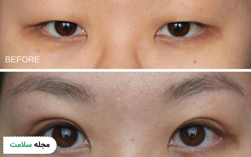 عمل زیبایی چشم آسیایی چیست؟