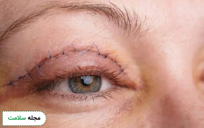 عمل زیبایی چشم بلفاروپلاستی