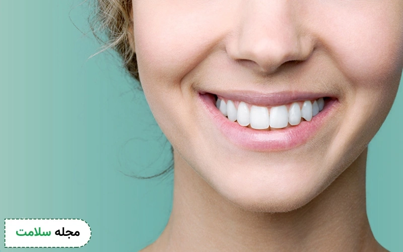همه چیز درباره بلیچینگ دندان که باید بدانید