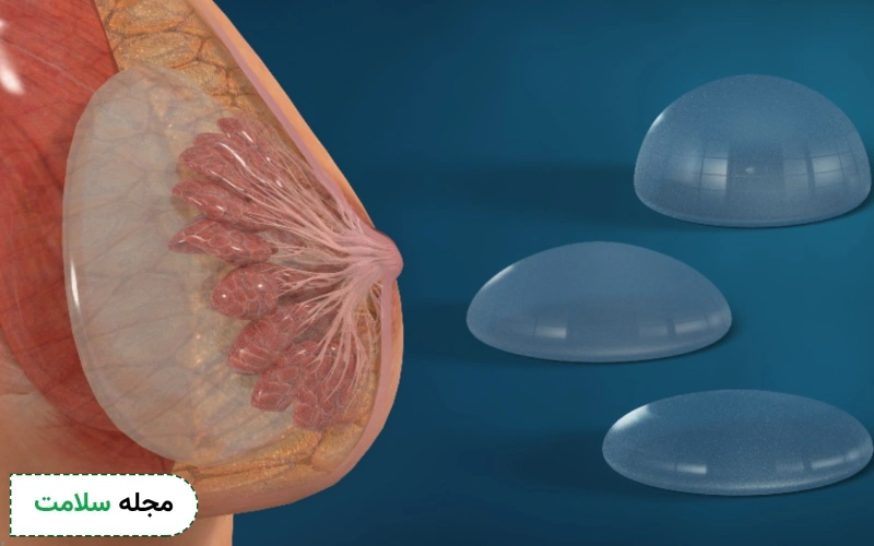 محل قرار گرفتن ایمپلنت سیلیکونی در سینه