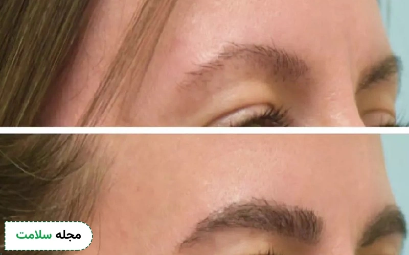 عکس قبل و بعد کاشت ابرو