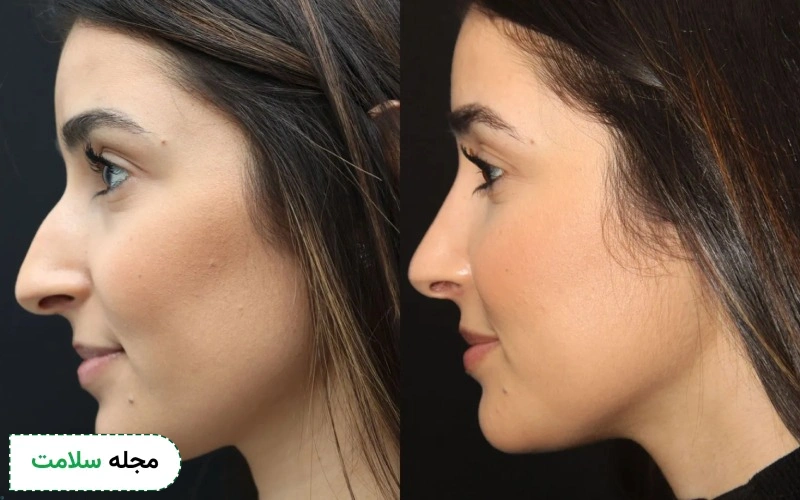 رینوپلاستی چگونه انجام میشود؟