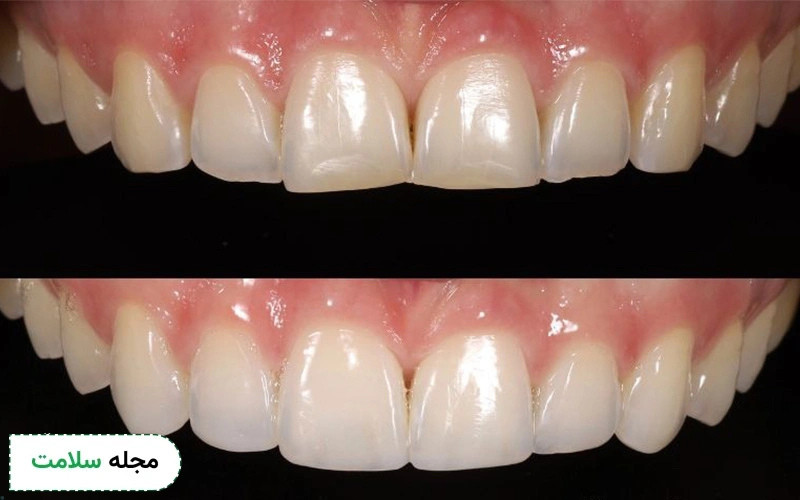 عکس کامپوزیت دندان جلو