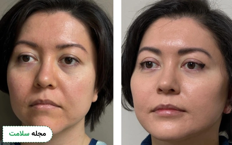 عکس قبل و بعد لیفت