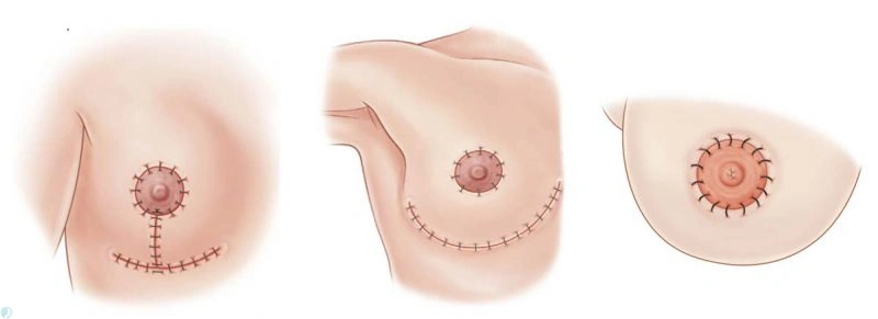 انواع برش در ماموپلاستی