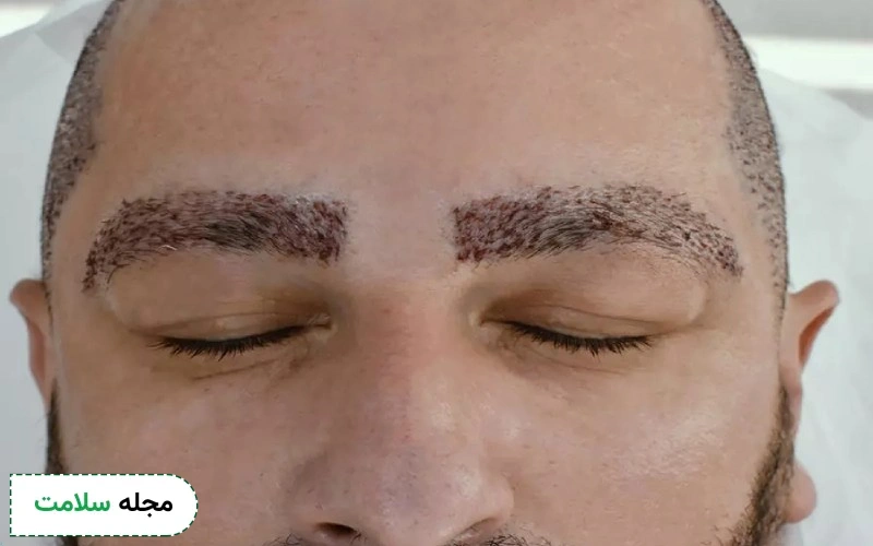 کاشت ابرو آقایان