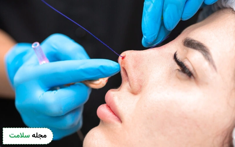 لیفت بینی با نخ چیست؟