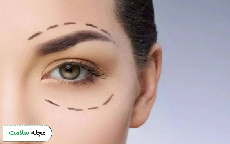 عمل زیبایی چشم، راه حلی دائمی برای داشتن چشمانی جذاب