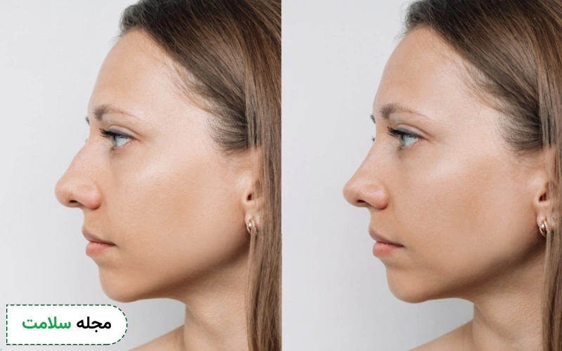 چه کسانی می توانند رینوپلاستی کنند؟