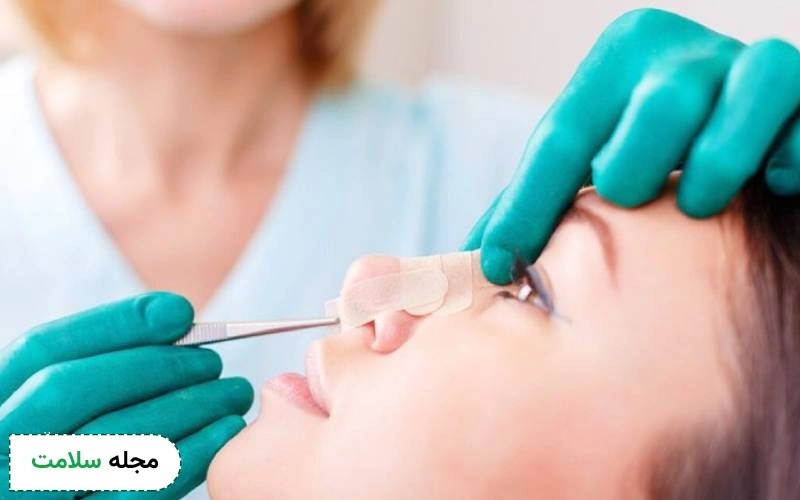 عمل زیبایی بینی و پاسخ به تمام سوالاتی که در ذهن دارید