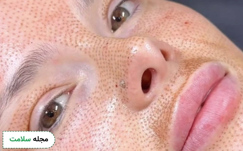 عکس لیفت بینی با پلاسما جت