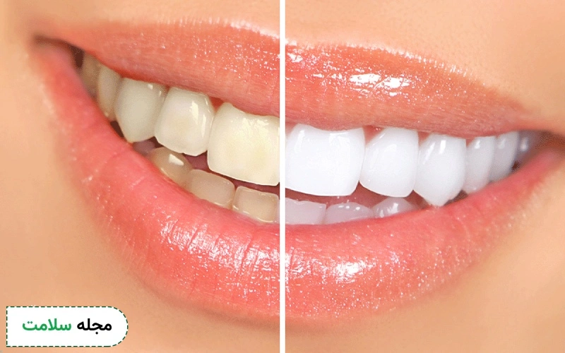 عکس بلیچینگ دندان