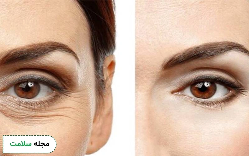 جدیدترین عمل زیبایی چشم