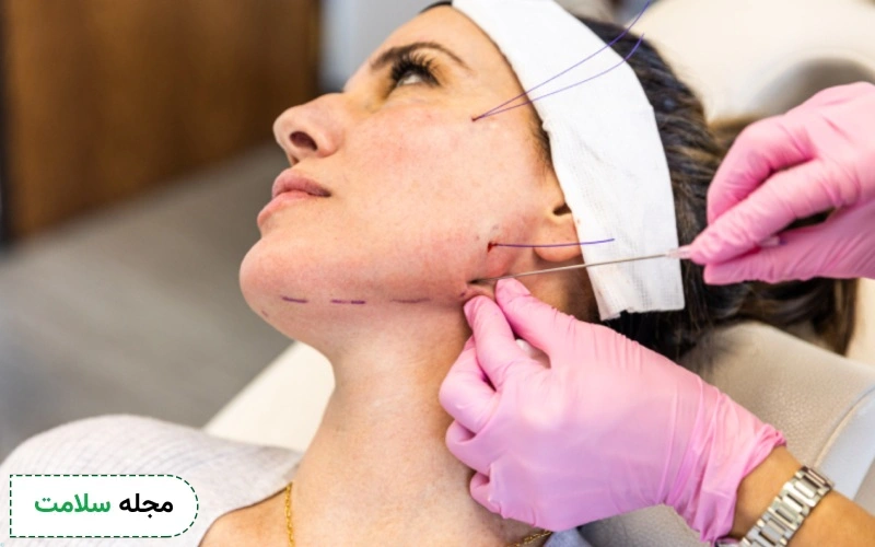 عکس لیفت صورت با نخ
