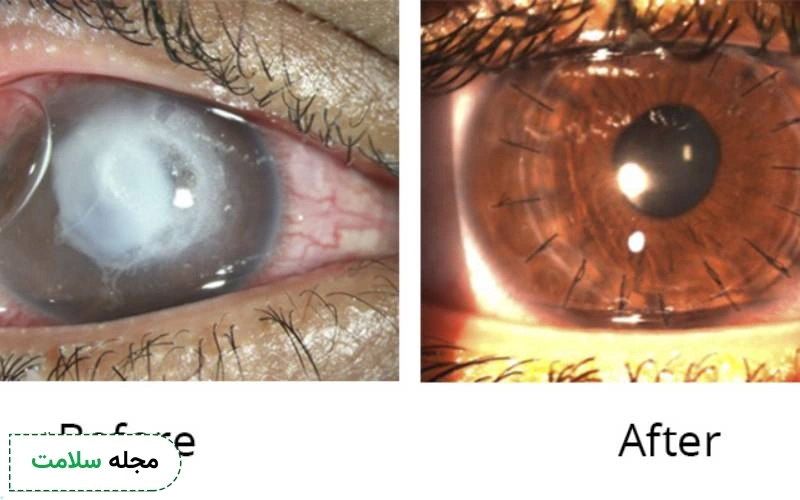عمل زیبایی قرنیه چشم