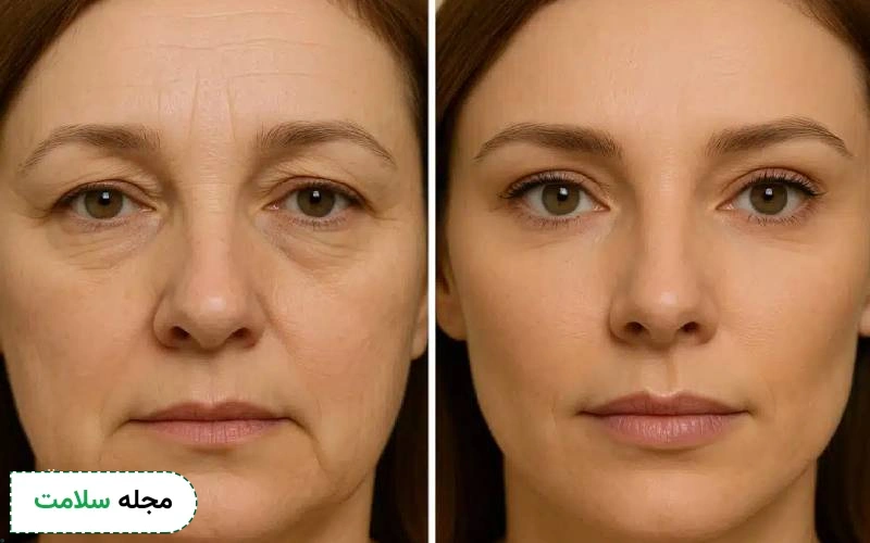 عمل زیبایی چشم گربه ای