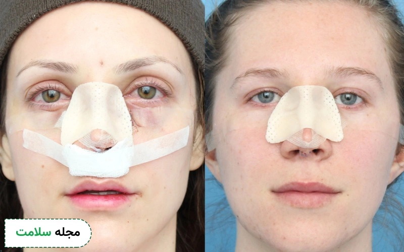 مراقبت های قبل و بعد از رینوپلاستی چیست؟