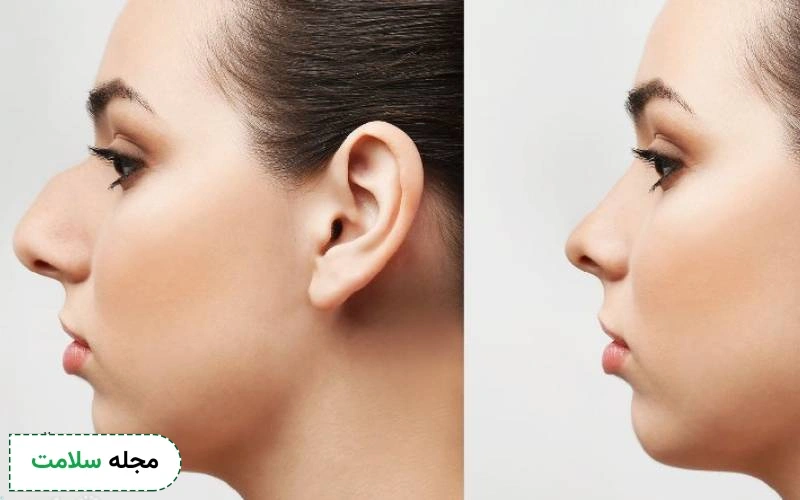 انواع عمل زیبایی بینی