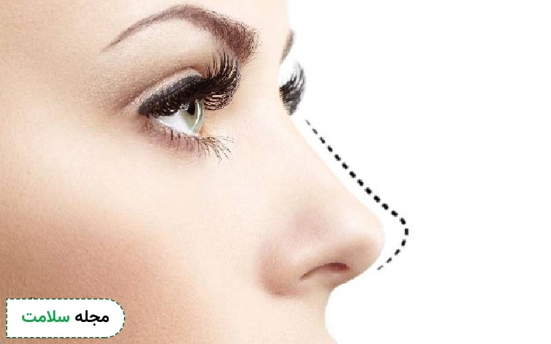 عمل زیبایی بینی های گوشتی و جراحی زیبایی بینی های غضروفی