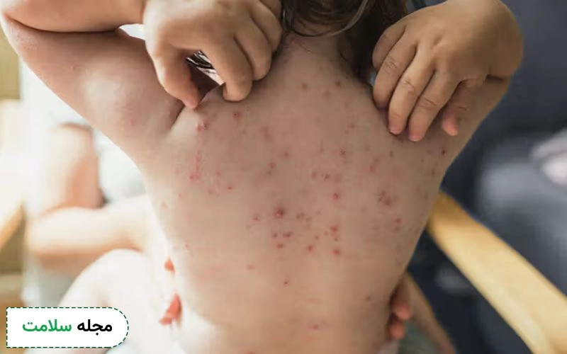 آیا مصرف قرص ضد خارش آبله مرغان برای کودکان ایمن است؟