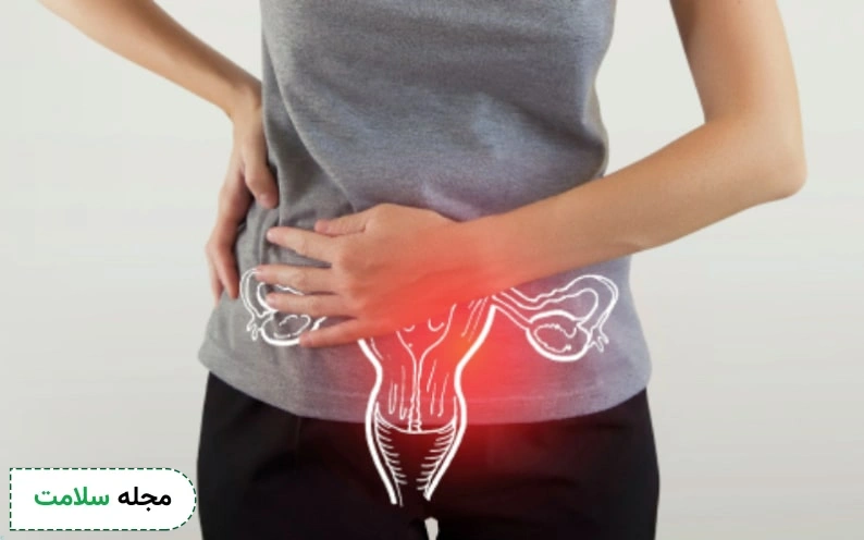 درمان کیست تخمدان راست