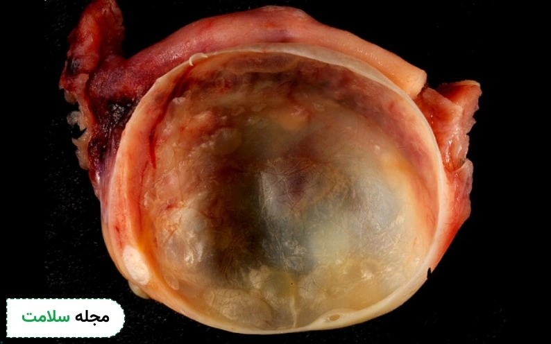 درمان کیست تخمدان در زنان یائسه