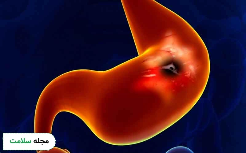 انواع داروهای سرطان معده خوش خیم چه هستند؟