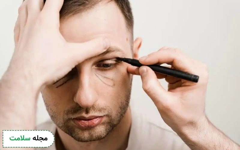 آیا همه بیماران بعد از بلفاروپلاستی به کرم ترمیم‌ کننده نیاز دارند؟