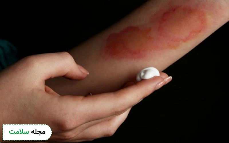 بهترین پماد برای سوختگی با آب جوش چیست؟