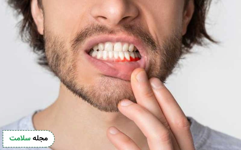 قرص لوپراکس برای آبسه دندان مفید است.