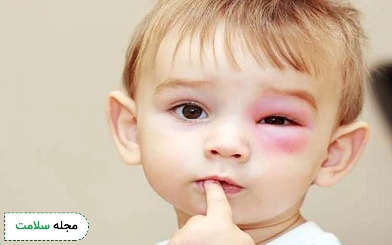 پماد برای گل مژه کودکان چیست؟