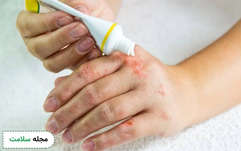 پماد کلوتریمازول چیست و برای چه چیزی استفاده می شود؟