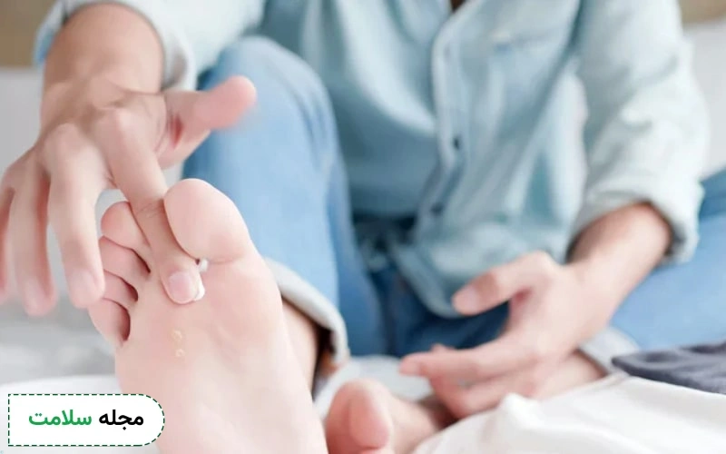 پماد سیکلوپیروکس برای قارچ پوستی موثر است.