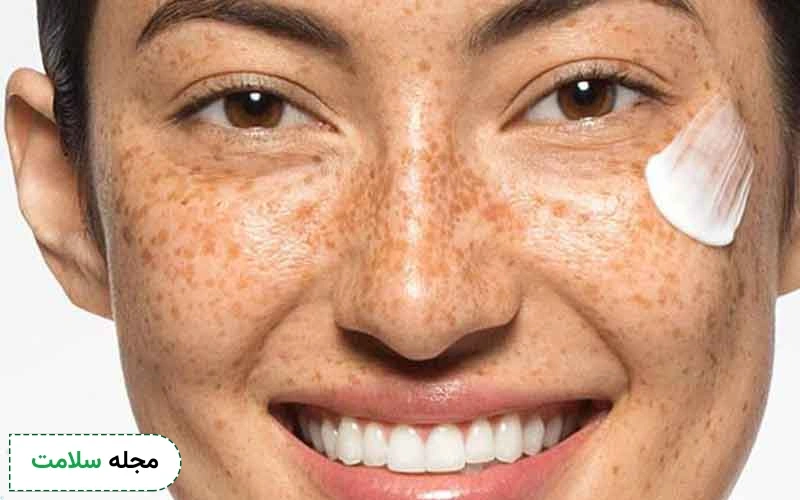 پماد دپانتکس برای لک صورت مفید است.